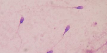 코로나19 감염, 남성 정자 절반으로 줄어든다