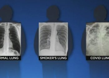 “코로나 19 감염자, 흡연자의 폐상태보다 나빠져”