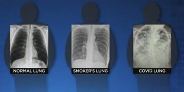 “코로나 19 감염자, 흡연자의 폐상태보다 나빠져”