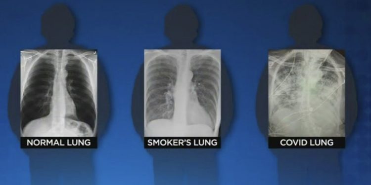 “코로나 19 감염자, 흡연자의 폐상태보다 나빠져”