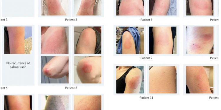 모더나 백신 접종 후 피부 발진 부작용 … CDC “큰 문제는 없다”