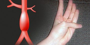 예일대 “손가락으로 대동맥류 가능성 알 수 있다”