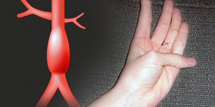 예일대 “손가락으로 대동맥류 가능성 알 수 있다”