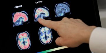 FDA, 알츠하이머 신약 조건부 승인