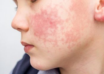 달라스 주민, 나이지리아 여행후 원숭이수두 감염 … 러브필드 공항통해 입국