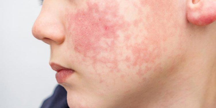 달라스 주민, 나이지리아 여행후 원숭이수두 감염 … 러브필드 공항통해 입국