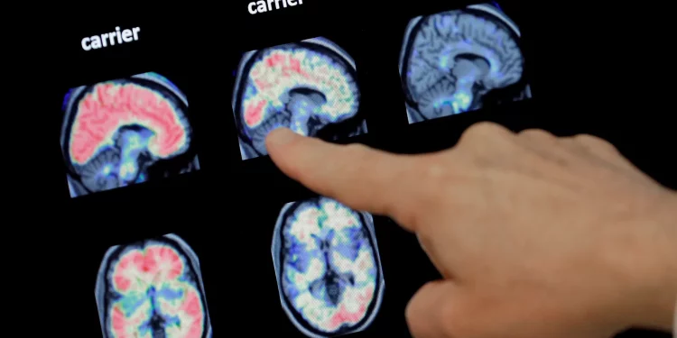 경미한 인지장애(MCI), 치매로 이어질 가능성 최대 15%