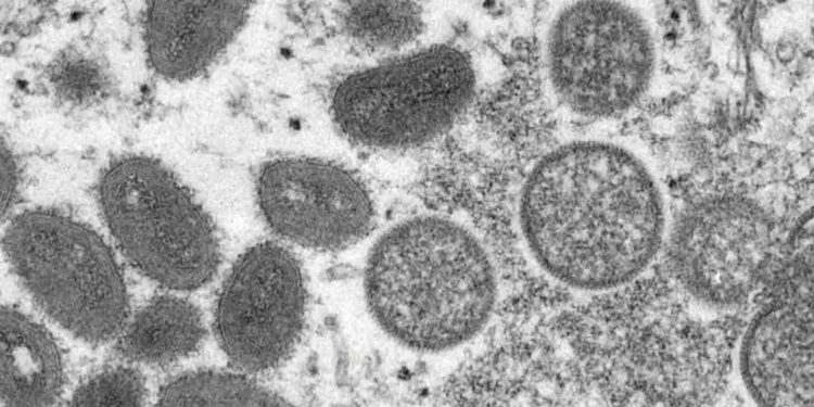 원숭이두창, 19개 국가에서 감염 확인 … ‘미국 2건’