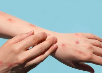 텍사스 원숭이 두창 확진 80명 … “한달만에 텍사스 전역으로 퍼져”