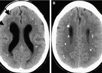 아이에게 발생한 이유없는 두통? … “코로나로 인한 뇌질환 가능성”
