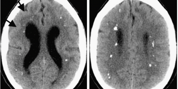 아이에게 발생한 이유없는 두통? … “코로나로 인한 뇌질환 가능성”
