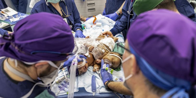 포트워스 쿡 어린이병원, 샴쌍둥이 분리 수술 성공