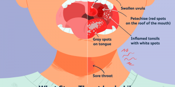인두염 제때 치료하지 않으면 ‘독성 쇼크 증후군’ 위험 증가