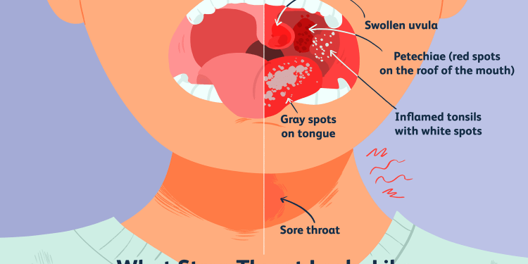인두염 제때 치료하지 않으면 ‘독성 쇼크 증후군’ 위험 증가