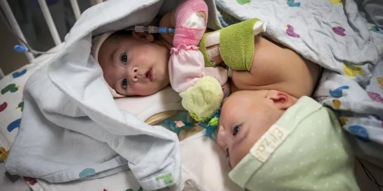 샴쌍둥이 분리수술 성공한 텍사스 어린이 병원 … “건강하게 퇴원”