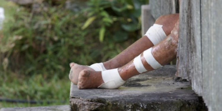 야생동물 ‘아르마딜로’를 애완용으로? … “한센병 발병 높인다”